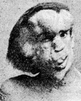 Joseph Merrick